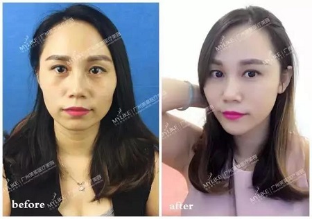 玻尿酸情人節(jié)特價？80元！