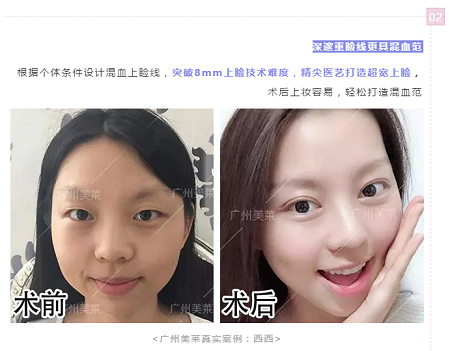 腫眼泡？重內(nèi)眥？