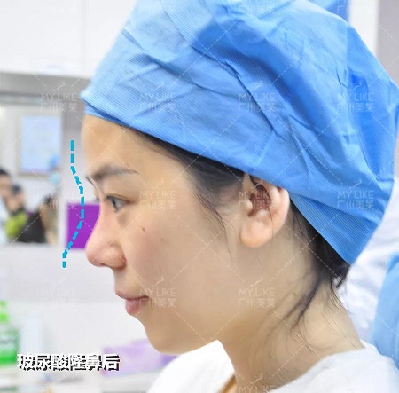 玻尿酸，僅需？80！