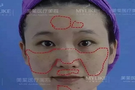 五官很好看，為什么不把臉上的斑去掉？