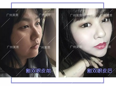 <a href='/ybzx/syp/' target='_blank'><u>割雙眼皮</u></a>后，“眼值”系數(shù)max！睜眼跪！