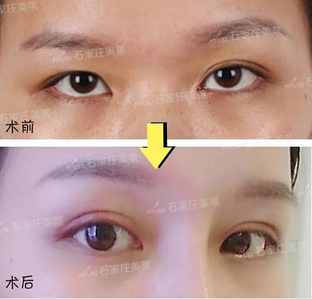 明星的眼和鼻，術(shù)后半個(gè)月Get專業(yè)混血臉！可萌可酷美翻了~