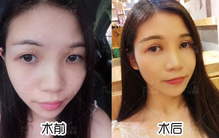 天生雙眼皮卻不好看？原因原來出在這！