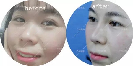 打了2支玻尿酸，她到底變啥樣了？