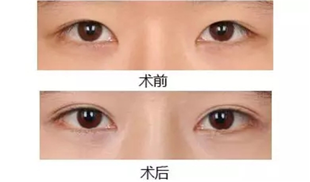 南京做韓式三點雙眼皮價錢是多少？