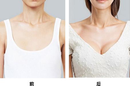 昆明乳房下垂矯正術(shù)費(fèi)用是多少？