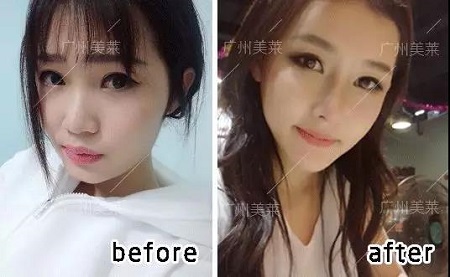 3年隆鼻案例回顧！她們用啥材料？隆了多少mm？