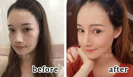 3年隆鼻案例回顧！