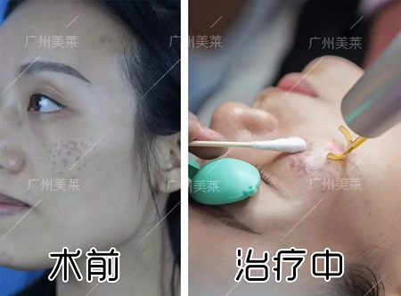 職場上的女強(qiáng)人，偏偏擺不平臉上這斑斑點(diǎn)點(diǎn)...