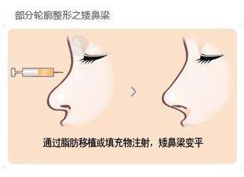 武漢注射玻尿酸隆鼻多少錢？