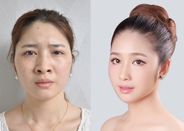 深圳假體隆鼻整形費用多少錢？