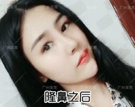 隆了個(gè)鼻，臉竟瘦了1圈？