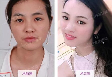 這幾種臉型妹紙，千萬別做面部脂肪填充?。?！