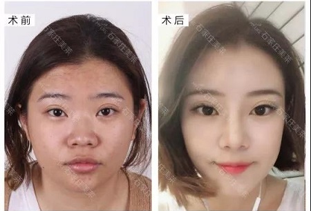 做完鼻整形，顏值逆風(fēng)翻盤！