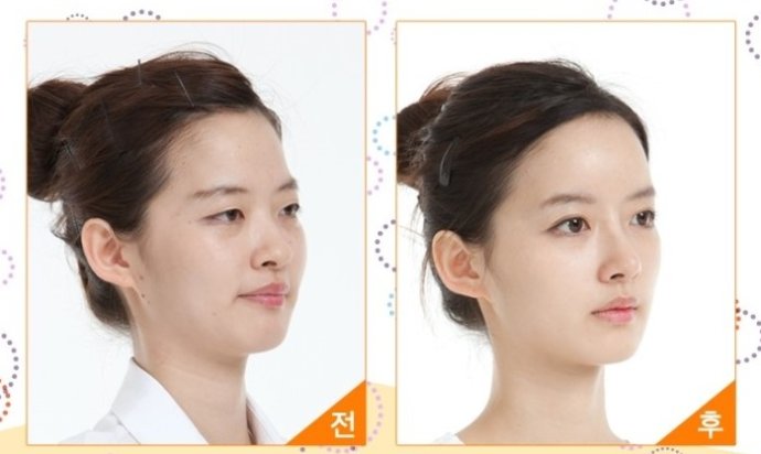 廣州鼻尖整形價(jià)格是多少錢？