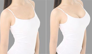 重慶自體豐胸手術(shù)價(jià)格是多少？