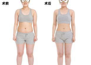 廣州吸脂價(jià)錢是多少？