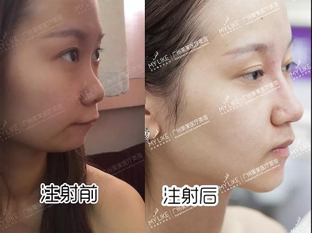 5個案例告訴你，玻尿酸即刻效果多明顯？！