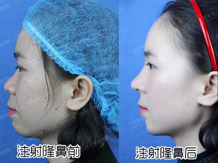 玻尿酸即刻效果多明顯？！