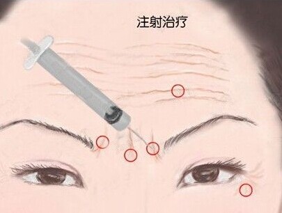 寧波注射除皺有哪些優(yōu)勢？