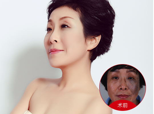 武漢深藍射頻價格是多少？
