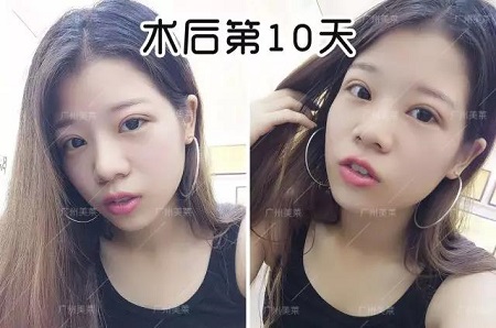 割雙眼皮后都可以出道了！