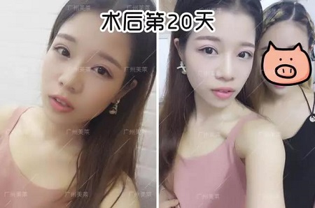 割雙眼皮后都可以出道了！