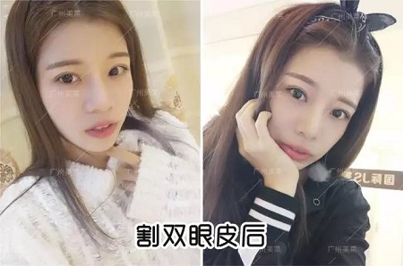 唱跳俱佳的她，割雙眼皮后都可以出道了！