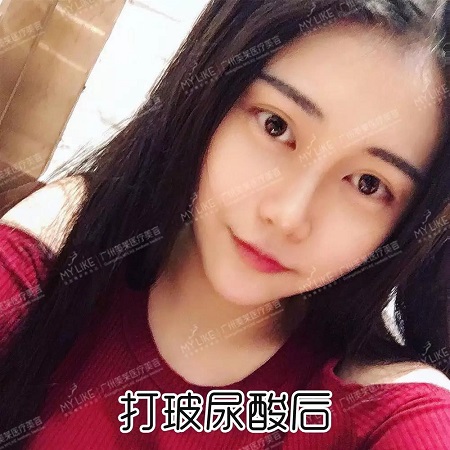 玻尿酸打這3個部位，立即換張臉！