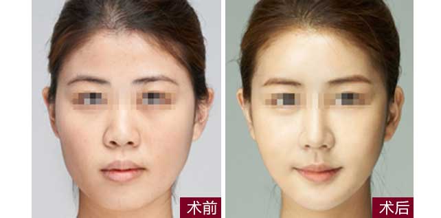 瘦臉一針需要多少錢？