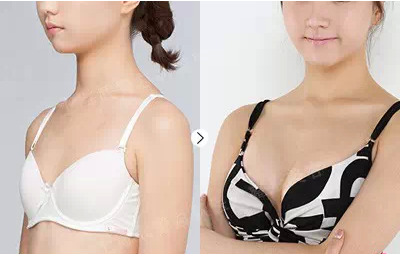 假體豐胸能保持幾年？