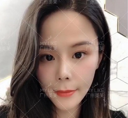 速美打造神奇——玻尿酸，讓你蛻變！