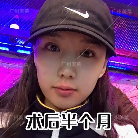 下垂眼割無(wú)辜桃花眼后，美成咋樣了？