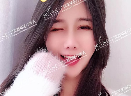 3個(gè)小姐姐真實(shí)分享，肋軟骨隆鼻感受！