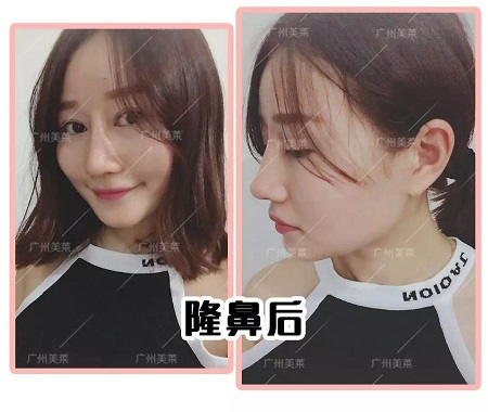 塌鼻進化史：“日拋鼻”我不爽你很久了！