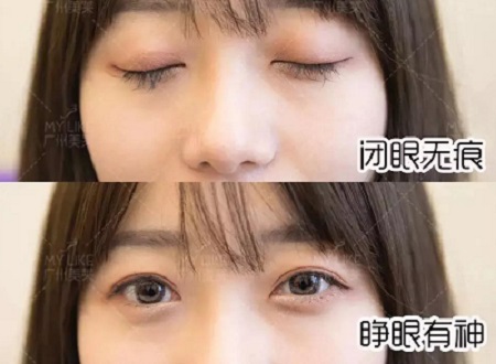 陰森小眼<a href='/ybzx/syp/' target='_blank'><u>割雙眼皮</u></a>后7天，竟如小鹿般精靈可愛？