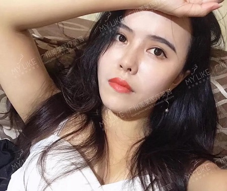 隆鼻后逆襲成女神？