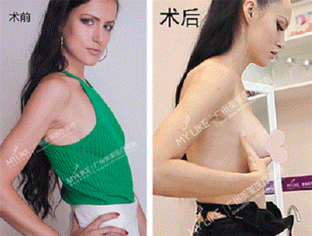 3月21日，國際乳房整容醫(yī)師穆大力來了！親診名額限量預(yù)約！