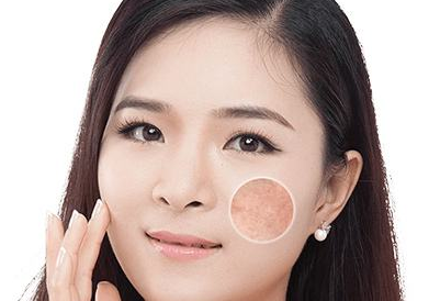 祛黃褐斑的價(jià)格大概是多少？