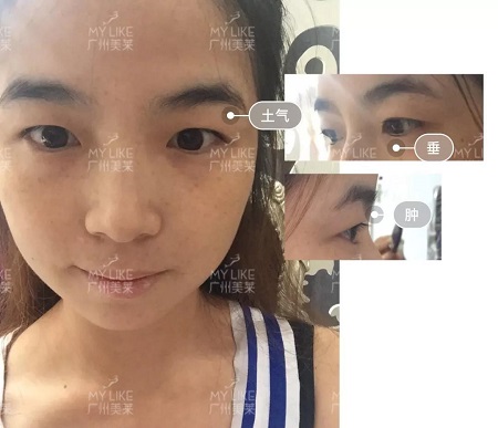 割完雙眼皮氣質(zhì)大變身?。?！