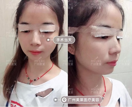 割完雙眼皮氣質(zhì)大變身?。?！