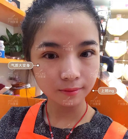 割完雙眼皮氣質(zhì)大變身?。?！