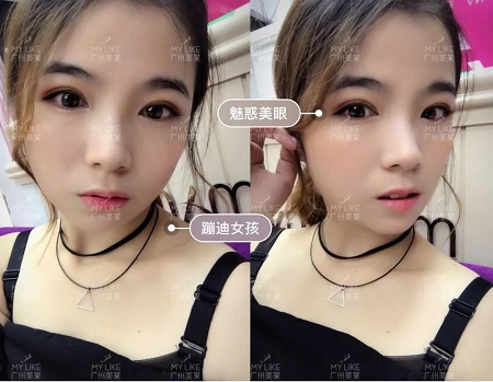 女生好的投資就應(yīng)該在臉上,割完雙眼皮氣質(zhì)大變身?。?！