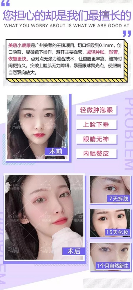 割完雙眼皮氣質(zhì)大變身！??！