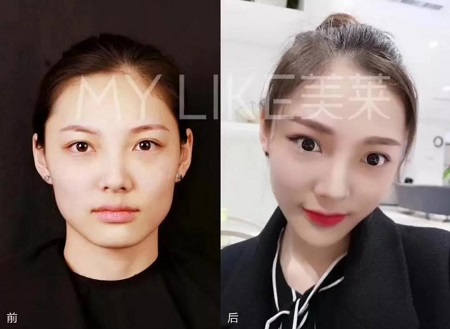 想打瘦臉針，這些事你都了解了嗎？