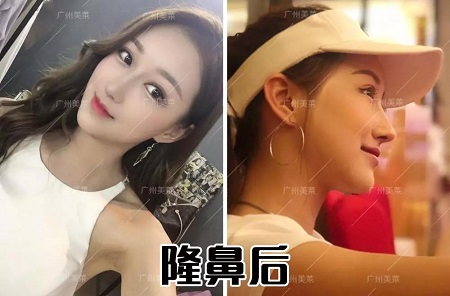 隆鼻3天后，從素人撞臉關(guān)曉彤？