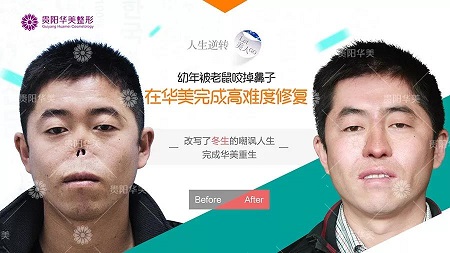 【真人秀】別再問隆鼻難不難做，沒有鼻子都能變出來！