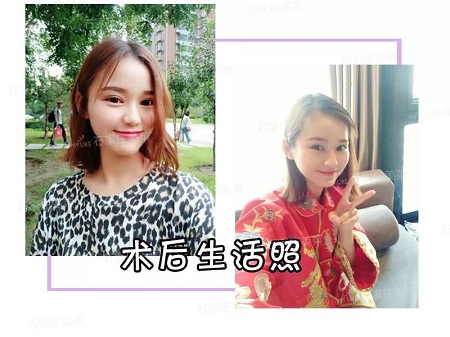 我近視做雙眼皮，對眼睛有影響嗎？圍觀小姐姐術(shù)后反饋！