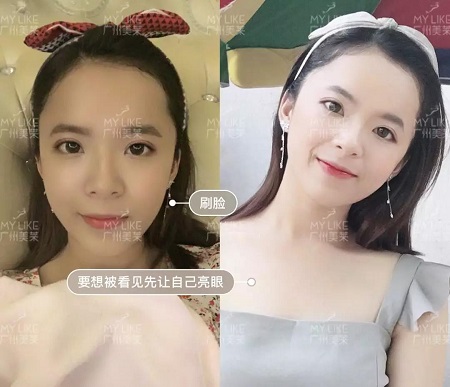 22歲畢業(yè)禮，竟被爸媽拉去割雙眼皮？！