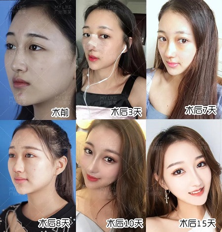 隆鼻后7天拆線，10天上妝美炸天！